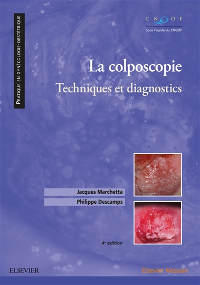 La colposcopie : technique et diagnostics