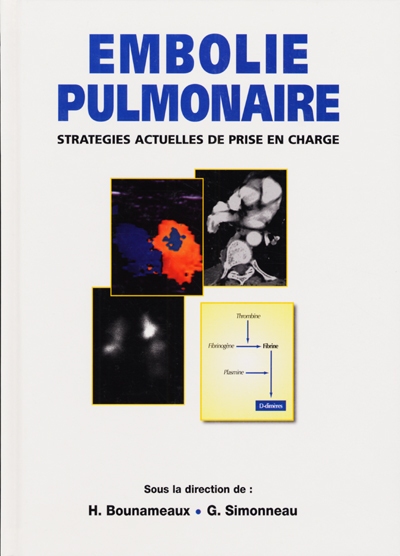 Embolie pulmonaire : stratégies actuelles de prise en charge