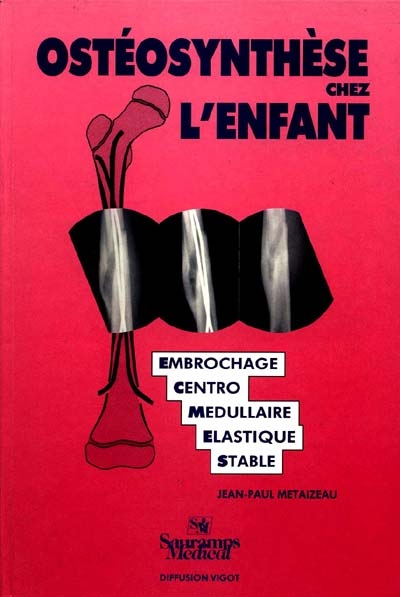 Ostéosynthèse chez l'enfant