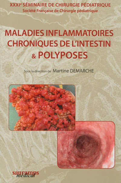 Maladies inflammatoires chroniques de l'intestin et polyposes