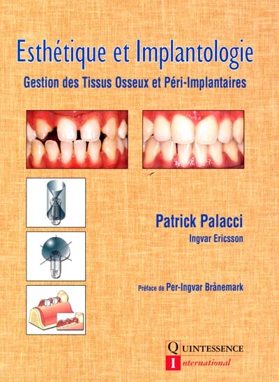 Esthétique et implantologie...