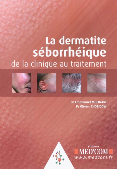La dermatite séborrhéique : de la clinique au traitement