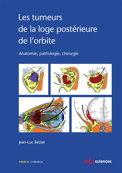 Les tumeurs de la loge postérieure de l'orbite : anatomie, pathologie, chirurgie. Vol. 3. Chirurgie