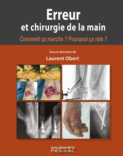 Erreur et chirurgie de la main : comment ça marche ? pourquoi ça rate ?