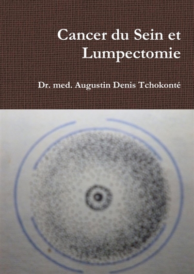 Cancer du Sein et Lumpectomie