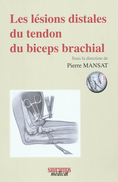 Les lésions distales du tendon du biceps brachial