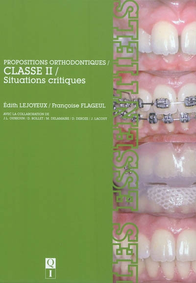 Propositions orthodontiques : classe II : situations critiques