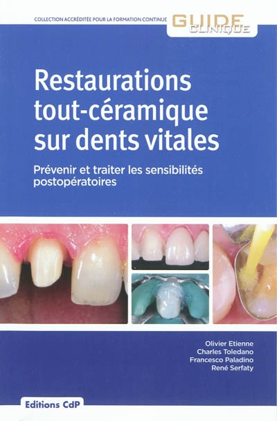 Restaurations tout-céramique sur dents vitales : prévenir et traiter les sensibilités postopératoires