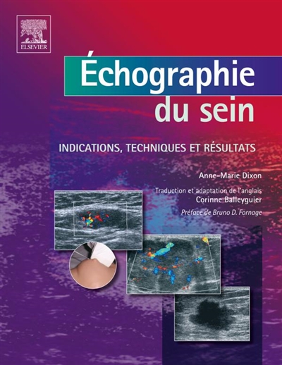 Echographie du sein : indications, techniques et résultats