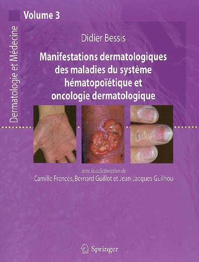 Dermatologie et médecine. Vol. 3. Manifestations dermatologiques des maladies du système hématopoïétique et oncologie dermatologique