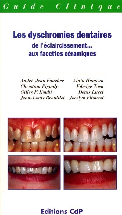 Les dyschromies dentaires : de l'éclaircissement aux facettes céramiques