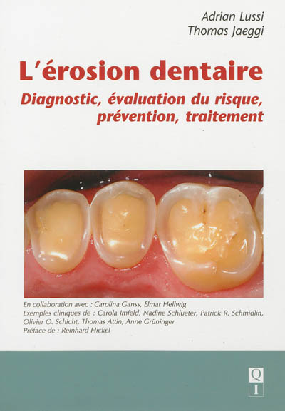 L'érosion dentaire : diagnostic, évaluation du risque, prévention, traitement