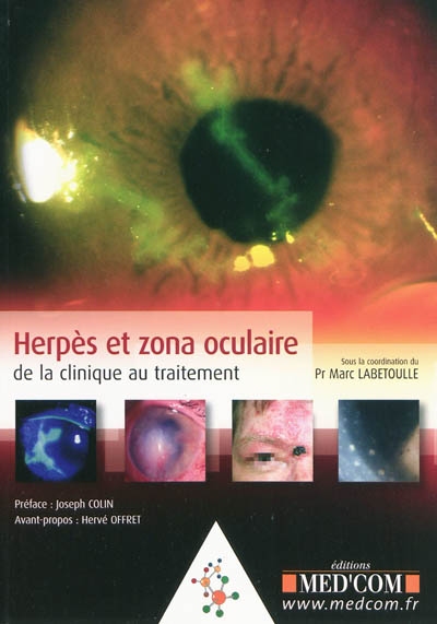 Herpès et zona oculaire : de la clinique au traitement