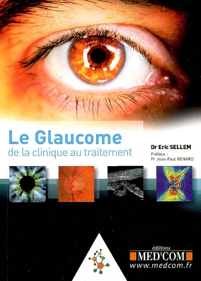 Le glaucome : de la clinique au traitement