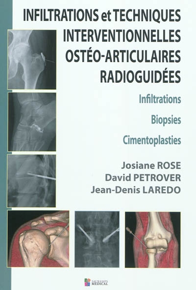 Infiltrations et techniques interventionnelles ostéo-articulaires radioguidées : infiltrations, biopsies, cimentoplasties