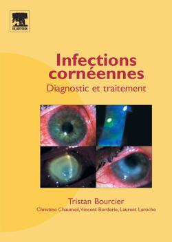 Infections cornéennes : diagnostic et traitement