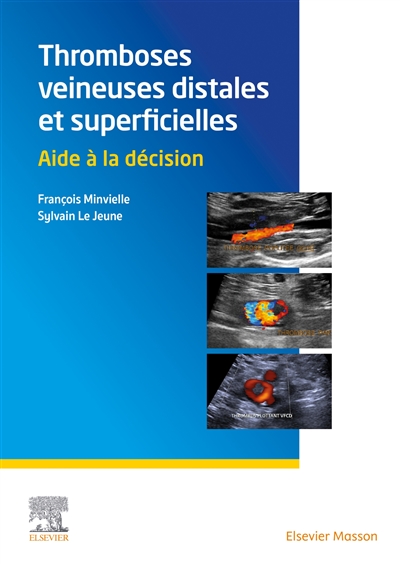 Thromboses veineuses distales et superficielles : aide à la décision