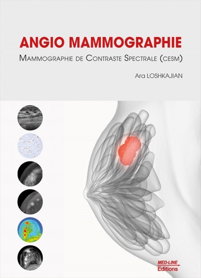 Angio mammographie : mammographie de contraste spectrale (CESM)