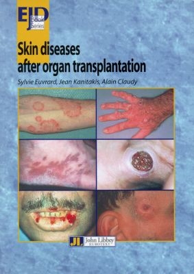 Skin diseases after organ transplantation