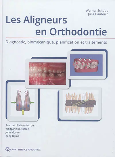 Les aligneurs en orthodontie : diagnostic, biomécanique, planification et traitements