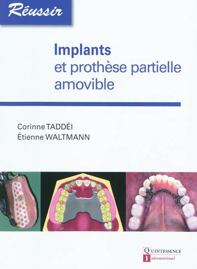 Implants et prothèse partielle amovible