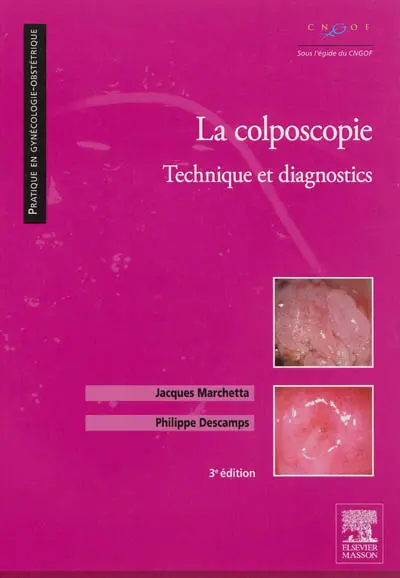 La colposcopie : technique et diagnostics