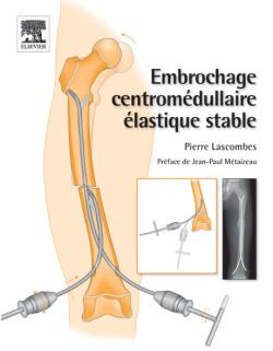 Embrochage centromédullaire élastique stable