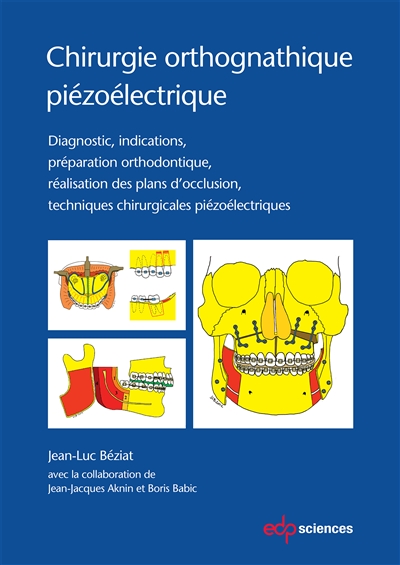 Chirurgie orthognatique piézoélectrique : diagnostic, indications, préparation orthodontique, réalisation des plans d'occlusion, techniques chirurgicales piézoélectriques