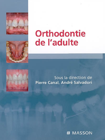 Orthodontie de l'adulte : rôle de l'orthodontie dans la réhabilitation générale de l'adulte