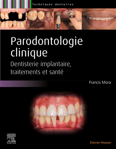 Parodontologie clinique : dentisterie implantaire, traitements et santé