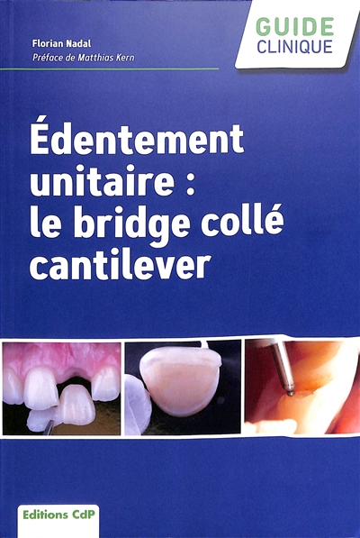 Edentement unitaire : le bridge collé cantilever