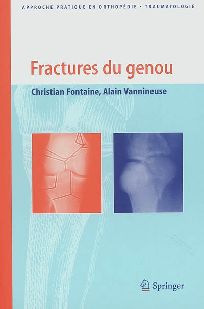 Fractures du genou