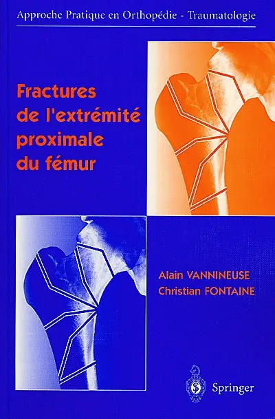 Fractures de l'extrémité proximale du fémur