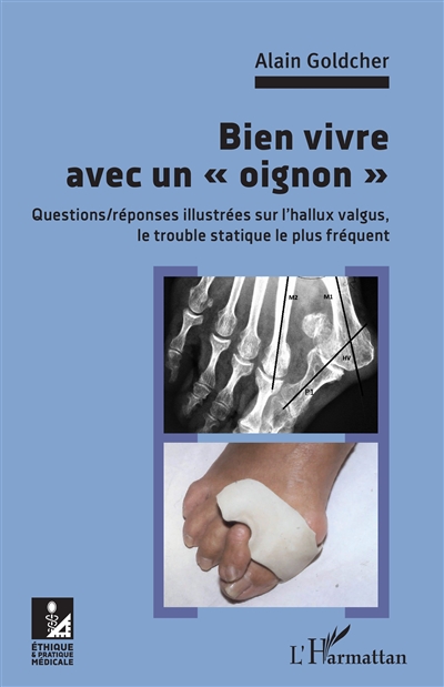 Bien vivre avec un oignon : questions-réponses illustrées sur l'hallux valgus, le trouble statique le plus fréquent