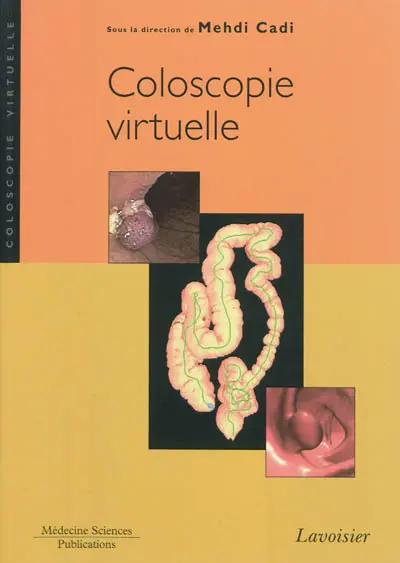 Coloscopie virtuelle Coloscopie virtuelle