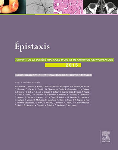 Rapport de la Société française d'ORL et de chirurgie cervico-faciale 2015. Vol. 2. Epistaxis