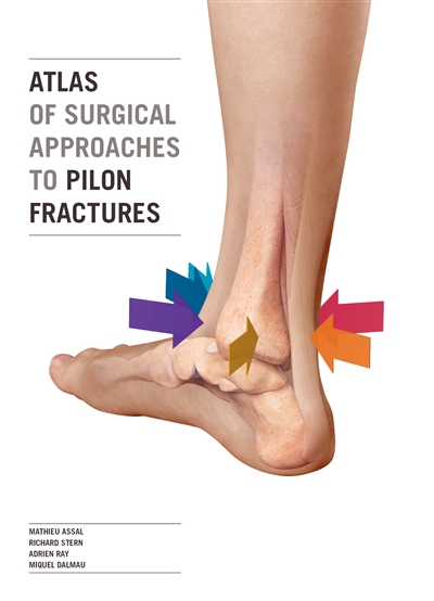 Atlas of surgical approaches to pilon fractures