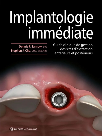 Implantologie immédiate : guide clinique de gestion des sites d'extraction antérieurs et postérieurs