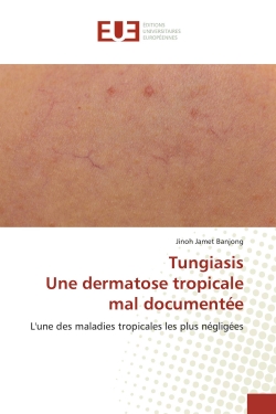 TungiasisUne dermatose...